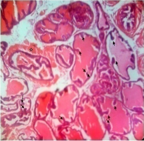 Figure 5. Photomicrograph of prostate tissue section of a rat from group 5 (BPH-induced and treated with 400 mg/kg of CME) showing reduced intraluminal secretions (star) in the seminal vesicle ducts which keeps for possible focal squamous metaplasia and projections of papillary (appears hyperplastic and arranged as stalks protruding in lumen of the duct) (black arrow) keeping for possible benign condition. Also, the ducts are distended due to the presence of papilloma usually called squamous papilloma. There is presence of few inflammatory infilterates (blue arrow) keeping for possible hyperplasia usually called reactive hyperplasia found in the seminal vesicles. H&E. mag. 400X.