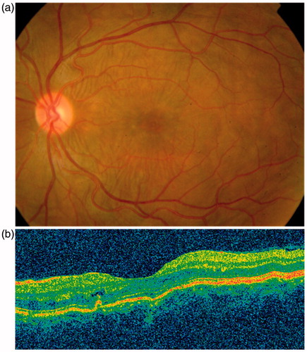 Figure 4. (a) Retinography and (b) OCT of the LE with retinal folds.