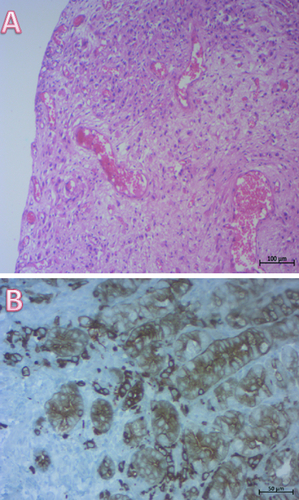 Figure 3. Histological examination of bladder biopsies.(A) Diffuse infiltration of the bladder mucosa by poorly cohesive neoplastic cells (HE × 100). (B) important immunostaining of neoplastic cells by keratin (×200).