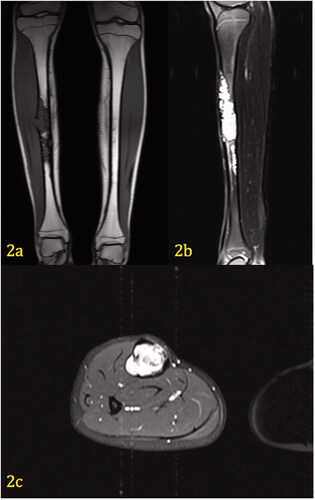 Figure 2. (a–c) Coronal T1 weighted image (2a) demonstrates hypodensity of a tibial lesion. Sagittal fat-saturated T2 weighted image (2b) of the left tibia demonstrates marked hyperintensity of the lesion, which extends from the anterior to posterior cortex. Axial contrast-enhanced, fat-saturated T1 image (2c) through the mid diaphysis demonstrates marked enhancement of the soft tissue mass, which completely obliterates the marrow. The cortex is thinned, but there is no extension of mass beyond the periosteum. No edema is present within the musculature.