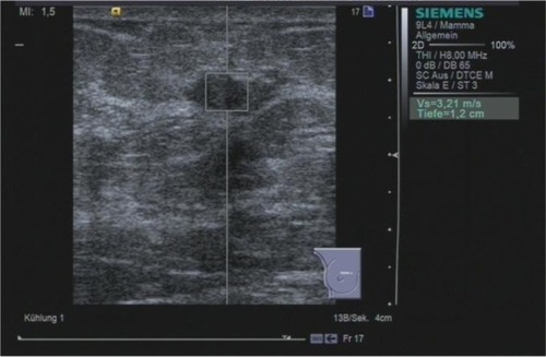 Figure 1 ARFI VTTQ of a benign breast lesion (fibrosis). The region of interest is set to the center of the lesion. Upon activation, a push pulse is generated, and detection pulses determine the velocity of the shear wave. Within milliseconds, the value (3.21 m/s) is returned.