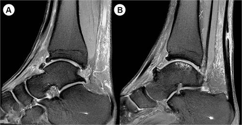 Figure 5 (A and B) Anterior bony impingement (spurs) accompanied by chronic ankle instability.