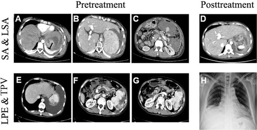 Figure 1 Imaging findings of severe complications after SAE. A–C show splenic (SA) and left subphrenic abscess (LSA); (A) Incrassation of diaphragm (arrow); (C) Air in the infarcted region (arrow); (D) The abscess is cured by surgery; E–G show left refractory pleural effusion (LPE) and thrombosis in portal vein (TPV); (F) Thrombosis in splenic vein (arrow); (G) Thrombosis in superior mesenteric vein (arrow); (H) The refractory pleural effusion is disappeared after the treatment of repeated thoracocentesis or thoracic closed drainage.