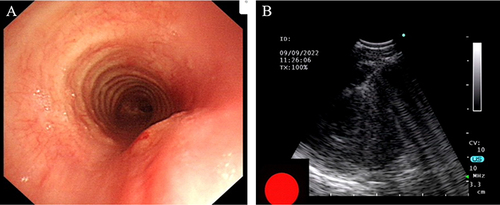 Figure 2 EBUS-TBNA showed (A) extratracheal pressure stenosis and (B) an unspecified echo mass at the 4–6 o’clock position in the 5cm trachea under the glottis.