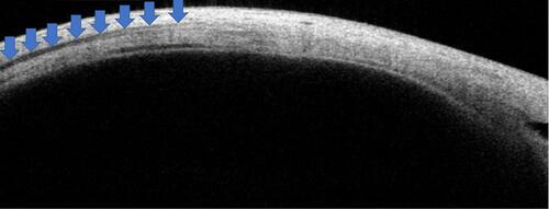 Figure 2 The muscles begin as a very faint hypoechoic area (corresponding with tendon) (anterior blue arrows) and then gradually appears as a well-defined hypoechoic area corresponding to the belly (posterior blue arrows).