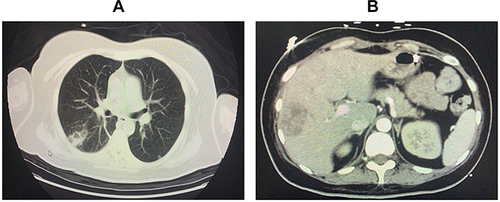 Figure 4 (A) Chest CT showing a lung abscess. (B) Abdominal CT showing a multilocular liver abscess.