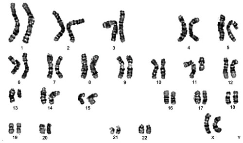 Figure 2 The frequent karyotype abnormalities in CLL are not mutually exclusive. Representative G-banded karyotype of a CLL showing deletions of the long arm of chromosome 11 as well as of chromosome 13: 46,XX,del(11)(q21),del(13)(q14).