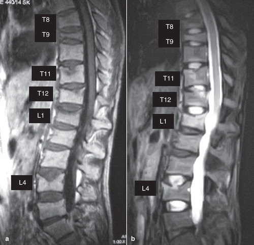 Figure 2. Magnetic resonance imaging (MRI) of the vertebrae in case 2. MRI showed low-signal intensities on T1-weighted images (A) and high intensities on T2-weighted images (B) at the 8th, 9th, 11th, and 12th thoracic vertebrae and 1st and 4th lumbar vertebrae.