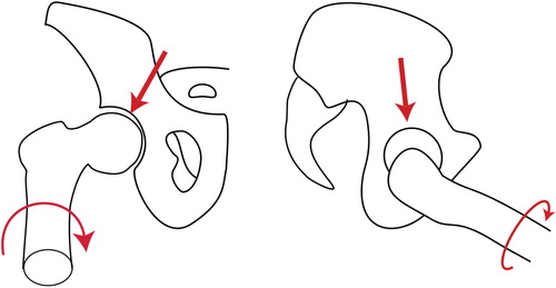 b. Anterior loading of the femoral head lead to an internally directed torque.