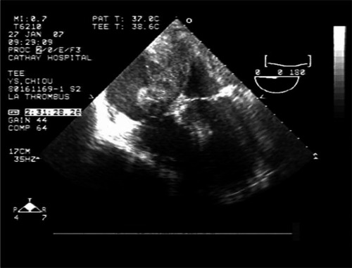 Figure 3 Transesophageal echocardiography showing tumor masses attached to the interatrial septum and protruding into both atrial cavities.