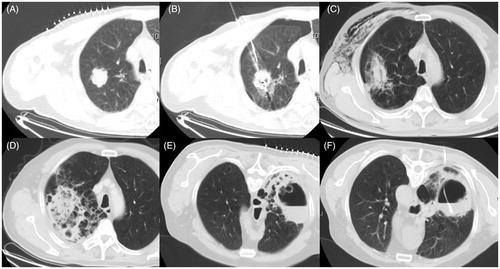 Figure 2. (A) A CT image from case 2 showing an isolated peripheral lesion of 36 × 35 mm located in the anterior segment of the right upper lobe. (B) MWA was performed with a mild pneumothorax. (C) A CT scan showing a minor pneumothorax and ipsilateral subcutaneous emphysema 3 days after MWA. (D) A CT scan depicting a flake of uneven and faveolate high-density shadow 3 weeks after MWA. (E) CT scan at 6 weeks after MWA showing an uneven thick-walled cavity with an irregular luminal surface, containing an air–fluid level and a beaded consolidation. (F) A drainage tube placed into the cavity under CT guidance.