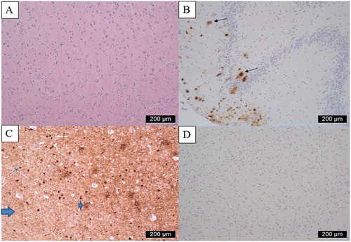 Figure 2. Neuropathological images of brain autopsy. *Abbreviations: ABC score; Amyloid βeta plaque score (A), Braak neurofibrillary tangles (NFT) (B), Consortium to Establish a Registry for AD (CERAD) neuritic plaque score (C). Neuropathological examination revealed a A3 B2 C2 score fitting an intermediate score for Alzheimer’s disease neuropathological change (Thal et al., Citation2002). A. Hematoxylin and eosin staining (HE) of second frontal gyrus displaying normal cellularity B Amyloid beta staining of hippocampus, Cornu Ammonis (CA) area 4, showing amyloid plaques Thal phase 4 out of 5 (A3)C AT8 staining of transentorhinal cortex, showing moderate presence of phosphorylated tau (NFT stage 2 (B2) as tangles (example thin arrow); neuropil threads (thick arrow) and as neuritic plaques (example arrow head). D Negative TDP-43 staining of second frontal gyrus