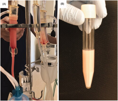 Figure 1. Milky fluid appeared on the venous side of the hemodialysis circuit. (A) Milky fluid was seen on the venous chamber (left) of the hemodialysis circuit, whereas it was not on the arterial chamber (right). (B) Milky fluid collected in the tube.