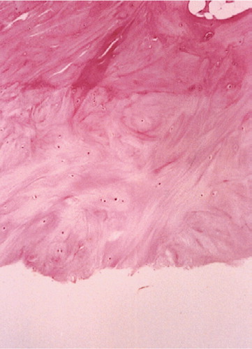 Figure 3. Type III:disappearance of the collagenous fiber layer and remaining reactive changes in the fibrocartilage layer (×100).