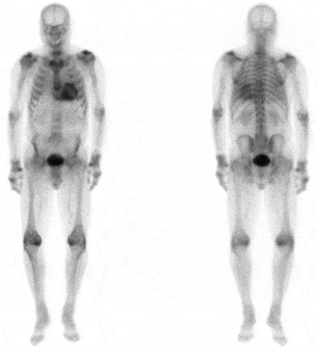 Figure 5. A) 99mTc labeledlabelled DPD scintigraphy demonstrating Perugini Grade 2 cardiac uptake in a patient with ATTR-CM