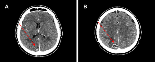 Figure 5 (A) Red arrows show brain metastases at baseline and (B) after 10 cycles of therapy with ribociclib.