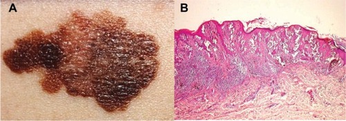 Figure 3 Illustrative pictures from a typical ulceration of CM form the face of an XP patient.