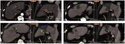 Figure 4. Top left: Pre-ablation HCC segmentation. Top right: Post-ablation segmentation of the necrosis volume. Bottom left: pre- post-ablation registration; the residual unablated nodule percentage is 0% and the residual unablated 5 mm margin is 12.5% (the solid portion outside the necrosis is the unablated safety margin). Bottom right: 1-year follow-up CT with necrosis segmentation showing no-LTP.