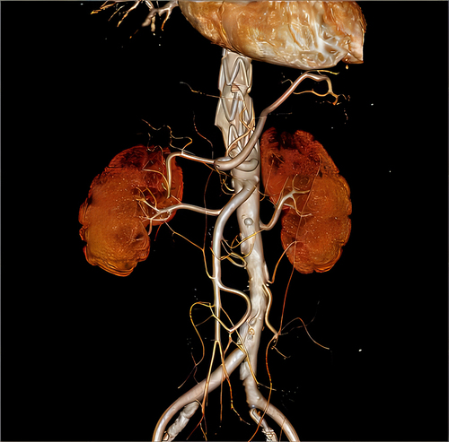 Figure 2 Three-dimensional computed tomography angiography shows the total exclusion of the aneurysm and the absence of endoleaks.