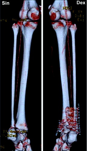 Figure 2. Computed tomography angiography revealing a vascular anomaly where a bilateral dominant peroneal artery was the only artery supplying vascularity to the foot.