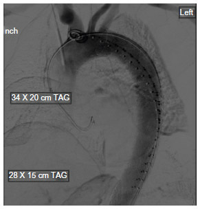 Figure 4 Intraoperative aortogram during endovascular repair of type B dissection.