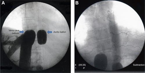 Figure 1 Cavography and aortography.