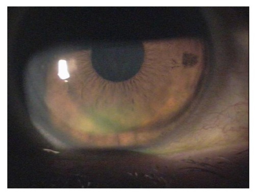 Figure 4 Epithelial sloughing with mild dislocation of flap in the eye of a diabetic patient after laser-assisted in situ keratomileusis.
