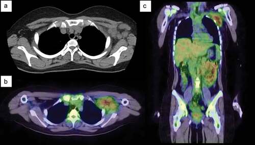 Figure 1. Chest computed tomography (CT) and gallium-67 single-photon emission-CT (SPECT) scintigraphy. (a) Chest CT on admission shows multiple enlarged lymph nodes in the left axilla. (b–c) Gallium-67 SPECT scintigraphy shows strong uptake in the axillary lymph nodes. No lymph node swelling or uptake is detected in other parts of the body.