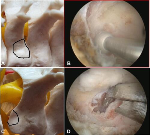 Figure 3 (A and B) Resection of the medial border of inferior articular process (IAP). (C and D) Superior articular process (SAP) medial resection and partial superior pediculectomy. Noted the black lines which encircled the medial border of the articular process.