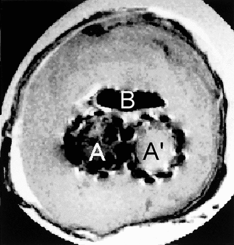 Figure 7 T1 weighted MR image.