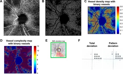 Figure 4 Mild glaucoma case (A) 6×6 mm2 en face image. (B) Skeletonized vessel image with large vessels removed. (C) Vessel density map with binary vessels, showing areas of higher vessel density in warmer colors. (D) Vessel complexity map with binary vessels, showing areas of greater vessel branching in warmer colors. (E) Cirrus OCT RNFL deviation map (top) and RNFL thickness by quadrant (bottom). (F) Probability total (left) and pattern (right) deviation maps.
