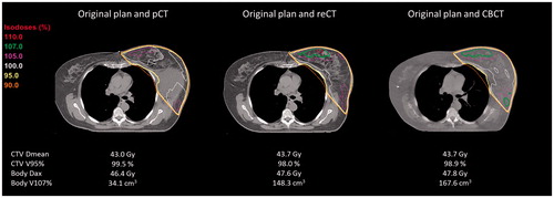 Figure 3. Example of a patient (PlanID 13) treated with a homogeneous dose to the left breast and axilla level 3 + 4 (16 x 2.66Gy) after lymph node dissection of an unknown primary lesion. Visualized are the original plan on the pCT, the re-calculation of the dose on the re-CT and stitched CBCT, respectively.