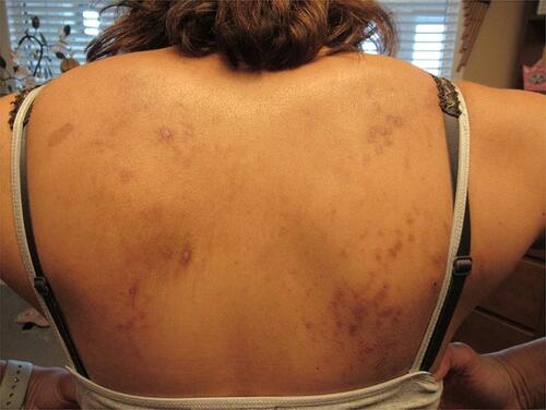 Figure 1 Ulcerated, punctate erosions with ragged edges on the patient’s back typical of Morgellons disease lesions.