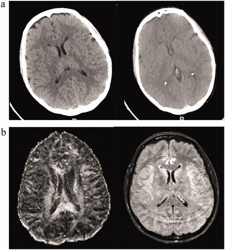 Figure 1. (a) Normal head CT of patient Case 1. (b) Brain MRI of patient Case 1 suggesting limbic encephalitis.