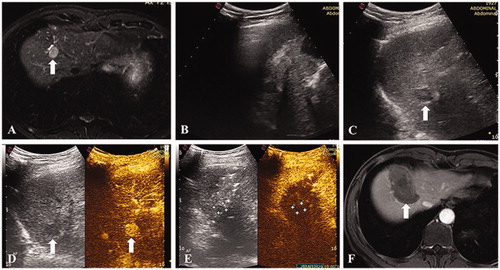 Figure 1. A 66-year-old male. (A) Contrast-enhanced MRI indicated a recurrent hepatocellular carcinoma located in segment 4/8 with a maximum diameter of 17 mm. (B) The nodule was partially visible and partially affected by the pulmonary gas. (C and D) The nodule became completely visible after one-lung ventilation and contrast-enhanced ultrasound confirmed the target location. (E) Thermal ablation was performed and immediate contrast-enhanced ultrasound demonstrated that the avascular zone covered the index tumor completely. (F) Contrast-enhanced MRI one month after the ablation procedure confirmed the technical efficacy.