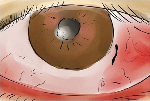 Figure 1 Sketch of the leech attached to the lower conjunctiva.