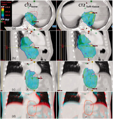 Figure 2. CT images, delineations and dose distributions for patient 18. Doses above 95% of prescribed dose are shown with dose colour wash for the PT plan. Orange and red contours represent the iCTV delineated on CT1 and CT2, respectively. Left column: bone match. Right column: soft tissue match. (a) transverse, (b) sagittal and (c) coronal view. Row (d) shows an overlay of CT1 and CT2 in coronal view. Turquoise is CT1, red is CT2.