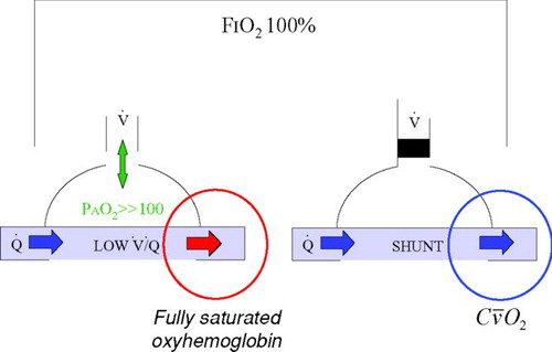 Figure 2 Effect of supplemental oxygen on ventilation-perfusion mismatch (low V˙/Q˙) and intra-pulmonary shunt (V˙/Q˙ = 0). When breathing 100% oxygen from a closed circuit (FIO2 100%), even lung regions with very low alveolar ventilation (on the left) should see an increase in alveolar oxygen tension (PAO2) to greater then 100 mm Hg in which case the blood draining that region will be fully saturated. By contrast, regions of intra-pulmonary shunt (on the right) experience no ventilation and the blood draining those regions has an oxygen content equal to the mixed venous blood (CDisplay full sizeO2).