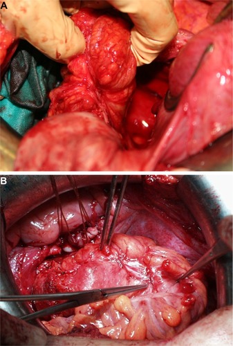 Figure 2 Deep infiltrating endometriosis showing location of intraluminal sigmoid tumor after hysterectomy and bilateral salpingo-oophorectomy.