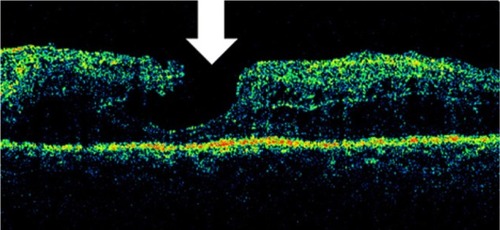 Figure 28 Stratus optical coherence tomography image.