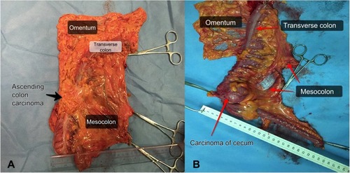 Figure 4 Specimen of ascending colon cancer in laparoscopic CME. The distance between the tumor and HVT is ~13 cm.
