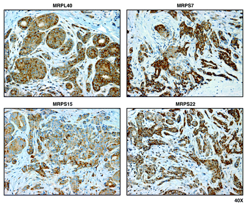 Figure 3. Mitochondrial ribosomal proteins (MRPL40, MRPS7, MRPS15, and MRPS22) are localized to epithelial cancer cells, but absent from adjacent tumor stroma, in human breast cancers. Paraffin-embedded sections of human breast cancer primary tumors were immunostained with antibodies directed against MRPL40, MRPS7, MRPS15, and MRPS22 (all mitochondrial ribosomal proteins). Note that immunostaining (brown color) is largely confined to the epithelial cancer cells. Original magnification, 40x.