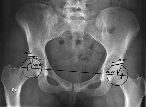 Figure 2. Example of output using the 2D dysplasia guide of the Sectra Planning System. AI = acetabular index angle (termed AIA in the text); CE = centre edge angle (termed LCEA in the text).