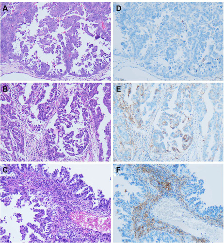 Figure 1 PD-L1 expression in endometrial serous carcinoma. (A–C) Representative area of endometrial serous carcinoma at medium power (H&E, 200x); (D) Corresponding negative PD-L1 expression;(E) Corresponding PD-L1 expression in tumor cells; (F) Corresponding PD-L1 expression in immune cells.