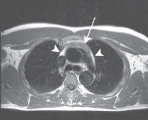 Figure 1 Axial T1 weighted image of the thymus of an antiretroviral treated nonhazardous drinker. The thymus (arrow) is of intermediate signal intensity with small amounts of higher intensity fat (arrowheads) around it.