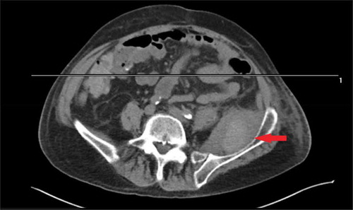 Figure 1. CT Scan without contrast of the left lower extremity indicating the mass (red arrow).