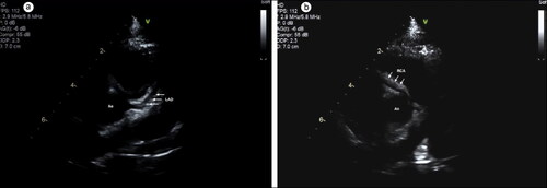 Figure 1. Echocardiogram demonstrating aneurysms (arrows). (a) Left anterior descending artery (3.2 mm, Z-score = 6.91). (b) Right coronary artery (3.1 mm, Z-score = 4.93).