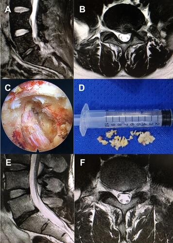 Figure 1 Pre- and postoperative MRI of a 56-year-old male with recurrent LDH who underwent revision PELD. The patient presented with recurrent pain of his low back and left lower extremity 12 months post the primary L5/S1 PELD surgery, but the conservative therapy failed to relieve the recurrent pain. Physical examinations on admission showed numbness involving the inferior aspect of his left foot, 3/5 strength in his left peroneus muscle, and 60° positive left straight leg raise test while the contralateral test proved negative. MRI demonstrated recurrent disc herniation on L5-S1, which was confirmed during the secondary L5/S1 PELD surgery afterwards. The patient had prominent pain relief and functional recovery postoperatively, and postoperative MRI showed decompressed spinal canal and foraminal area.