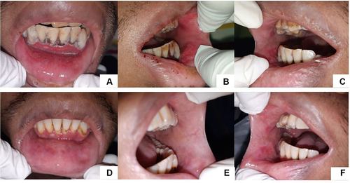 Figure 3 Greyish white plaques on mandibular anterior gingiva, erosion on lower labial mucosa (A). Erosion on left buccal mucosa (B). Erosion on left buccal mucosa (C). The lesion has improved (7 days) (D–F).