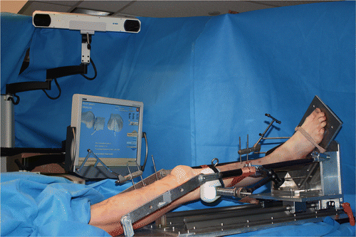 Figure 1. The experimental set-up for mechanized pivot shift testing. The lower limb is mounted in full extension on the mechanized pivot shifter, abducted by at least 15° at the hip joint. The foot is affixed to the base plate and is externally rotated. The base plate can then be pushed by the examiner along two linear bearing surfaces, effectively cycling the knee from 0° to 90° of flexion. Using a load cell attached to the mechanized pivot shifter through a three-degrees-of-freedom arm, a valgus load of 4–5 kg is applied to the proximal third of the tibia to reproduce the pivot shift phenomenon. The computer navigation system tracks the tibiofemoral motion path using a camera that emits and then captures a signal reflected by the passive reflective markers attached to the femur and tibia. The arc of motion during the pivot shift test is compared to a flexion-extension path acquired during the registration process of the intact knee and is then visually represented on the screen.